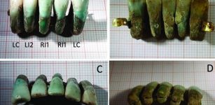 The dentures found in the tomb are the first example of dentures from this historical period, and as such are a valuable addition to the history of dentistry. Image Credits: Photo: University of Pisa via The Local