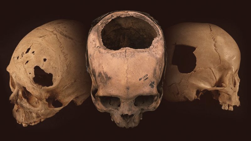 Ancient Peruvian brain Surgery