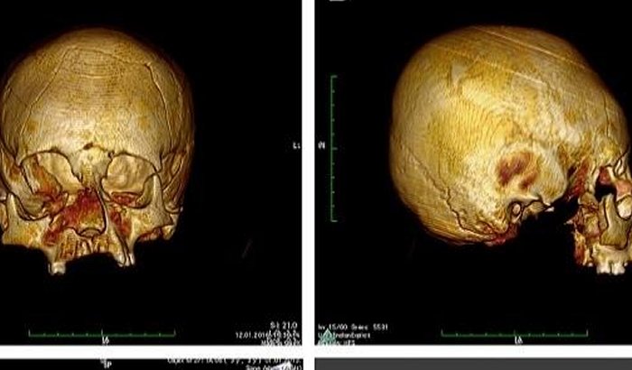 CT scans of the so called circular-erect type cranial deformation. CREDIT M Kavka