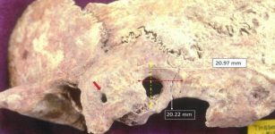 Ectocranial view of palaeopathological specimen: a) red arrow points to orifice on the mastoid process,and b) surgical preparation dimensions peripheral to trephination. Credit: Anagnostis P. Agelarakis/Adelphi University