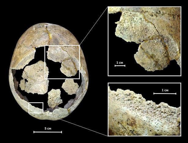 5,000-Year-Old Russian Skull Offers Evidence Of Brain Surgery Made With ...