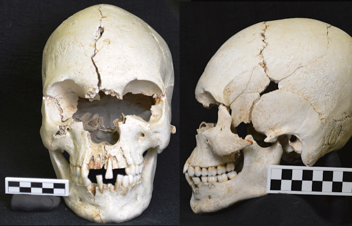 Ancient Caribbean Skull Shows Evidence Of Leprosy