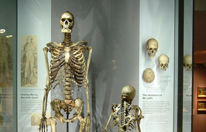 Skeleton Of Irish Giant Charles Byrne Will Not Be Displayed In The Hunterian Museum In London