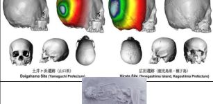 Japan's Ancient Practice Of Cranial Modification: The Case Of The Hirota People In Tanegashima