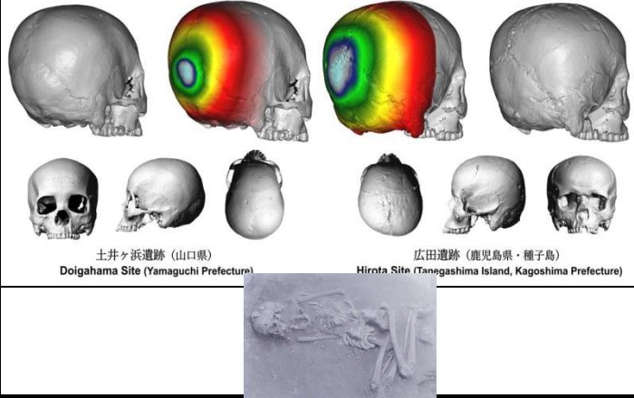 Japan's Ancient Practice Of Cranial Modification: The Case Of The Hirota People In Tanegashima